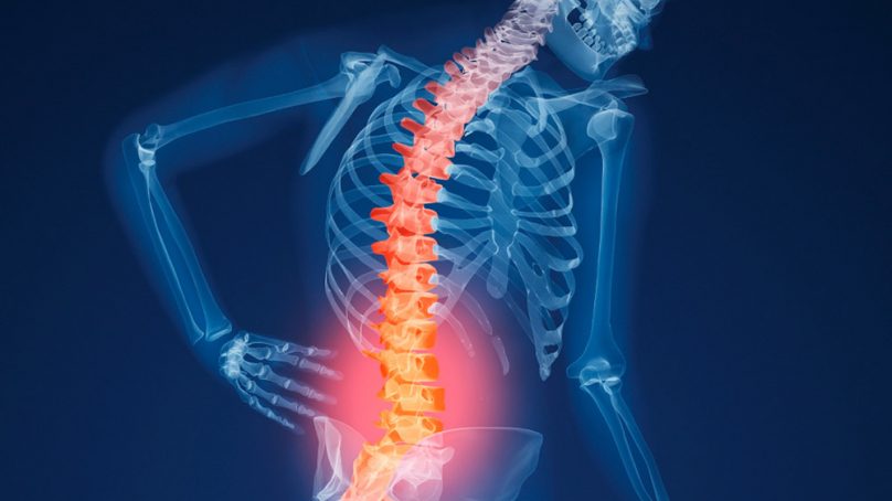 Caso Osteoporosi. Parere Medico Legale