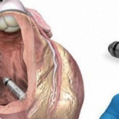 Ragusa: impiantato pacemaker di ultima generazione