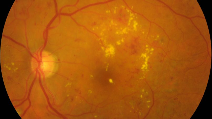 Siracusa, convegno sulla retinopatia diabetica