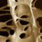 Osteoporosi sempre fanalino di coda della spesa farmaceutica.