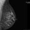 Focus sul carcinoma mammario il 23 Novembre al Plaza