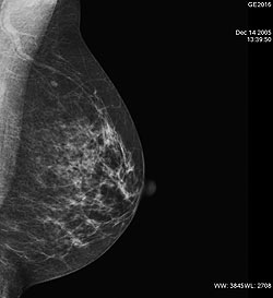Focus sul carcinoma mammario il 23 Novembre al Plaza