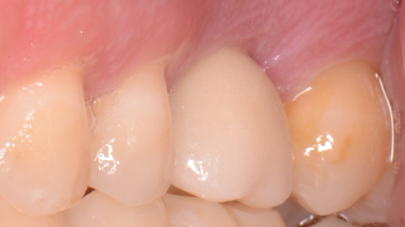 La gestione delle mucositi perimplantari e delle perimplantiti
