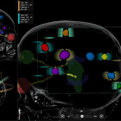 Trattamento delle metastasi cerebrali multiple