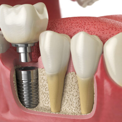 Odontoiatria, revisione narrativa di cinquant’anni di implantologia