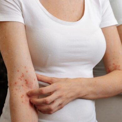 Scabbia: boom di casi e problemi terapeutici