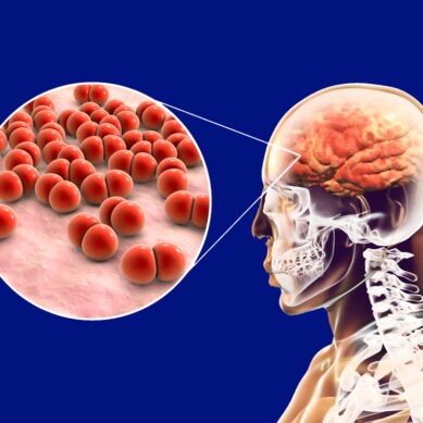 Recenti focolai di meningiti da Meningococco: processo patogenetico e vaccini