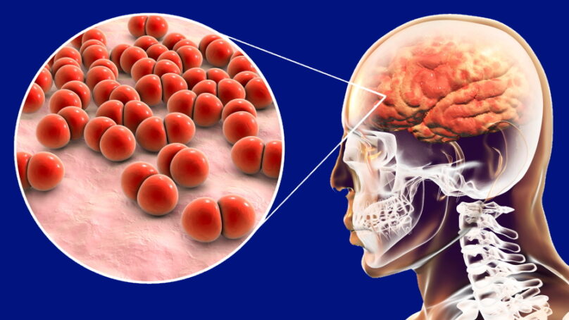 Recenti focolai di meningiti da Meningococco: processo patogenetico e vaccini