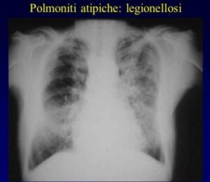 legionellosi 3
